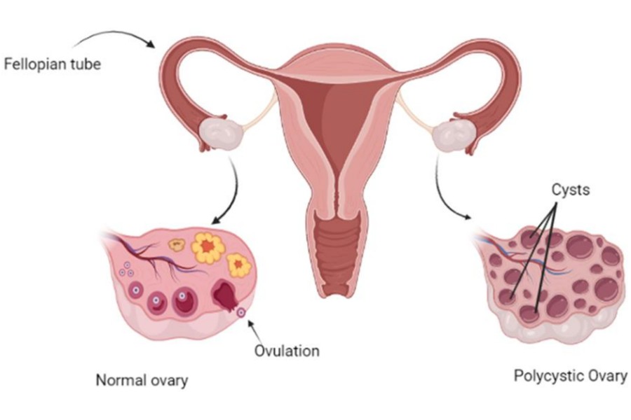 Diagram of a fallopian tube and ovary comparing normal ovulation with polycystic ovary changes