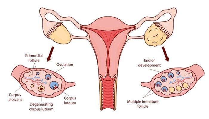 Diagram comparing a normal ovary with ovulation and a polycystic ovary with multiple immature follicles